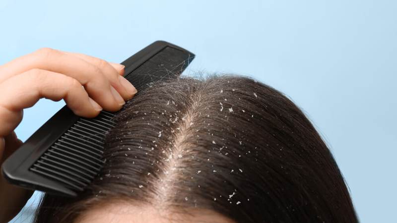 Kepek Şampuanı: Saçınızı Kepekten Kurtarmanın Etkili Yolu