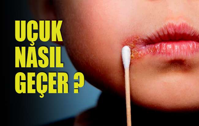 Uçuk nasıl geçer?