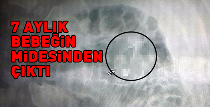 7-aylik-bebegin-midesinden.jpg